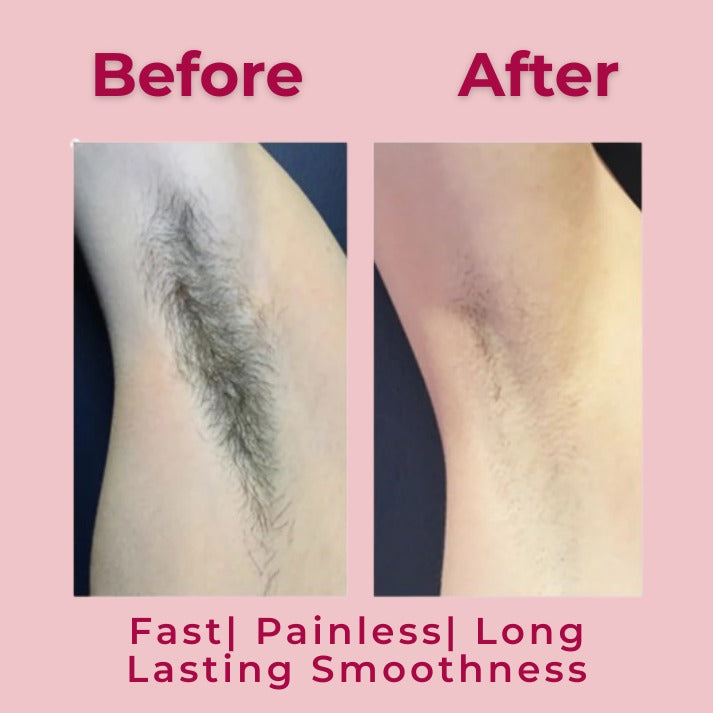 PERMENANT HAIR REMOVEL SPRAY